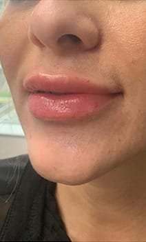 Lips after treatment