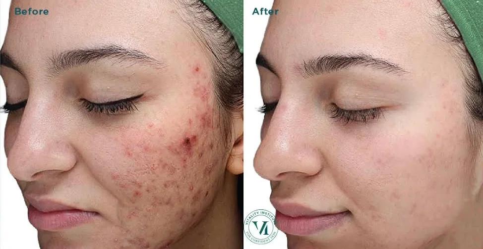 vi-peel-skin-c-houston-med-spa-houston-tx