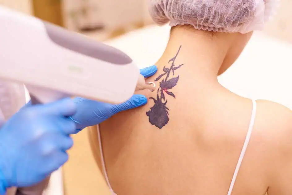 Laser Tattoo Removal at Houston, TX by Dream Aesthetics LLC